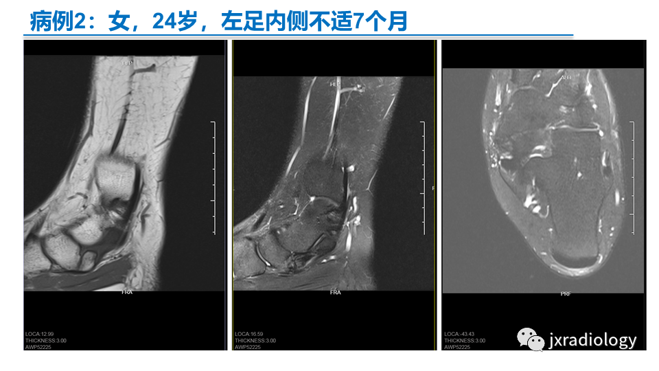 影像PPT - 【PPT】足副舟骨分型及相关病变-33