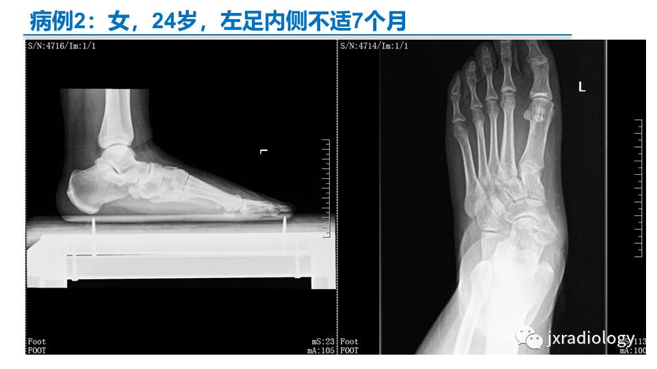 影像PPT - 【PPT】足副舟骨分型及相关病变-32