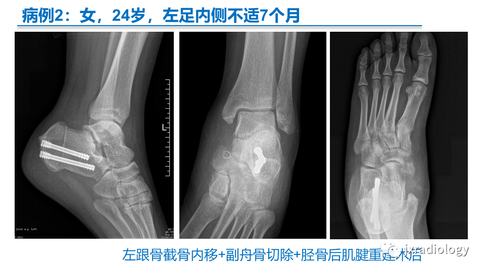 影像PPT - 【PPT】足副舟骨分型及相关病变-34