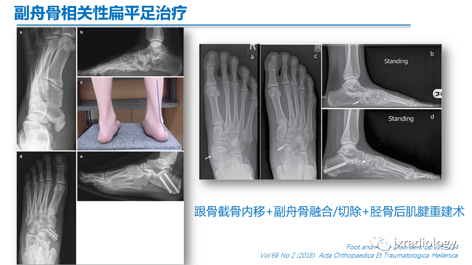 影像PPT - 【PPT】足副舟骨分型及相关病变-35