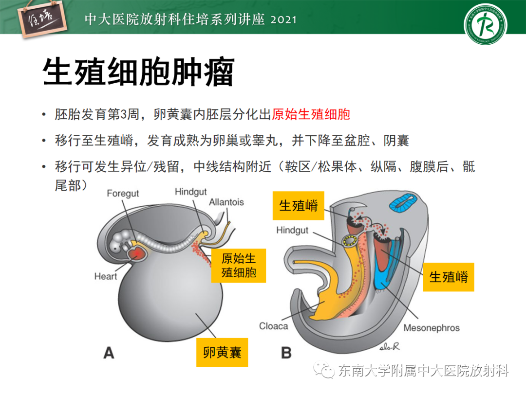 影像PPT - 【PPT】颅内生殖细胞瘤影像学表现及鉴别-2