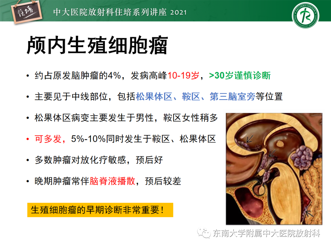 影像PPT - 【PPT】颅内生殖细胞瘤影像学表现及鉴别-5