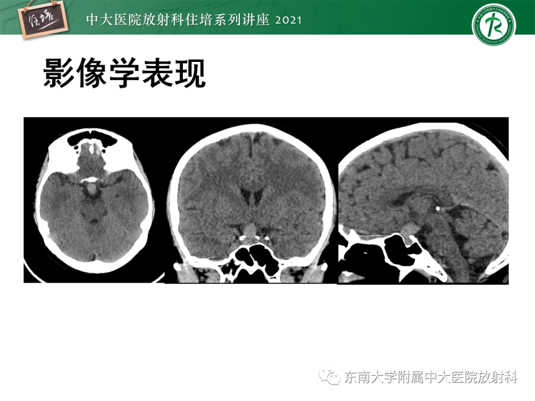 影像PPT - 【PPT】颅内生殖细胞瘤影像学表现及鉴别-7