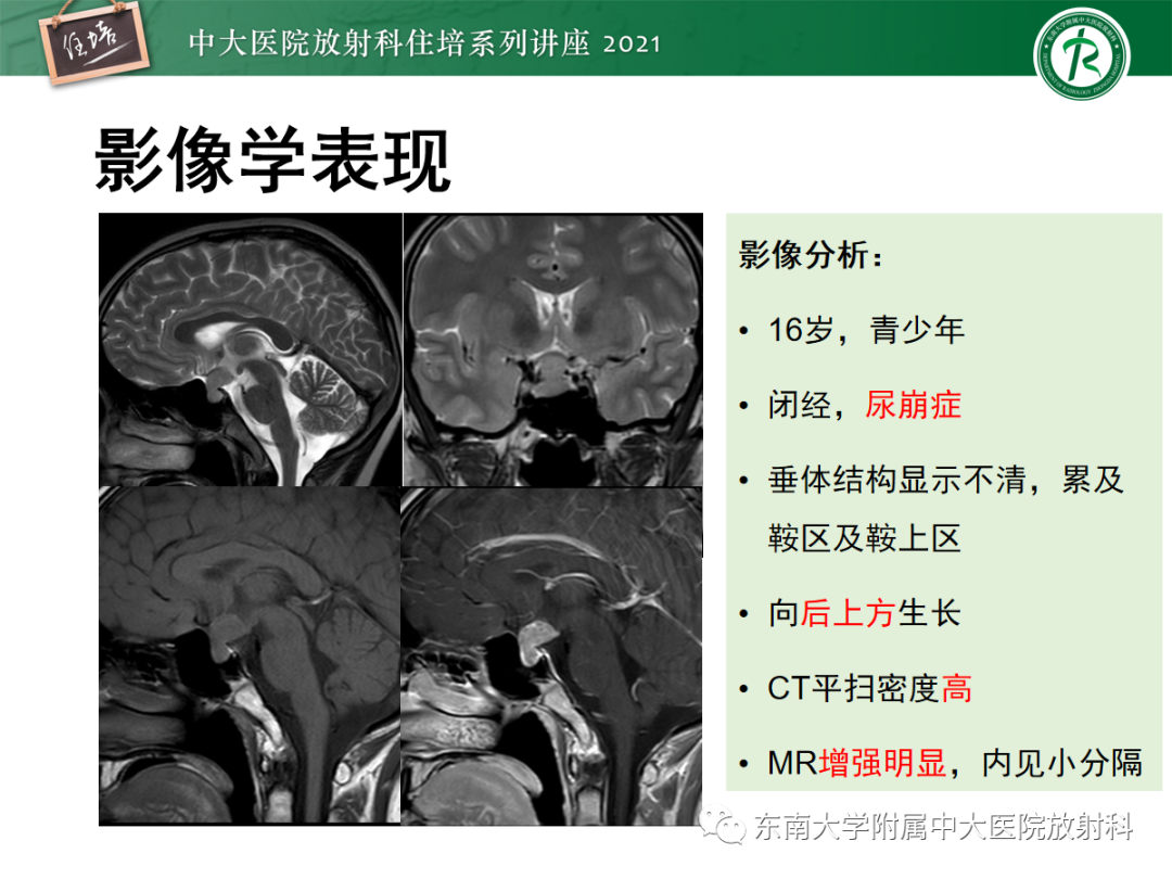 影像PPT - 【PPT】颅内生殖细胞瘤影像学表现及鉴别-8