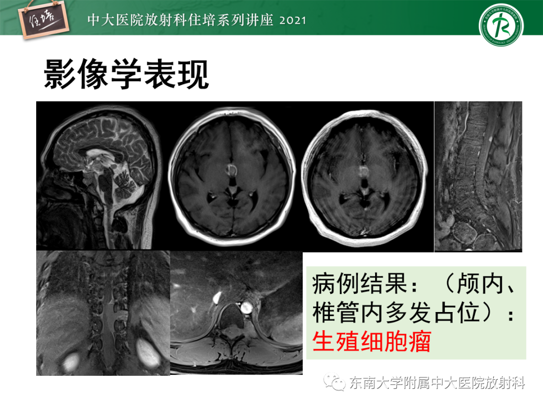 影像PPT - 【PPT】颅内生殖细胞瘤影像学表现及鉴别-12