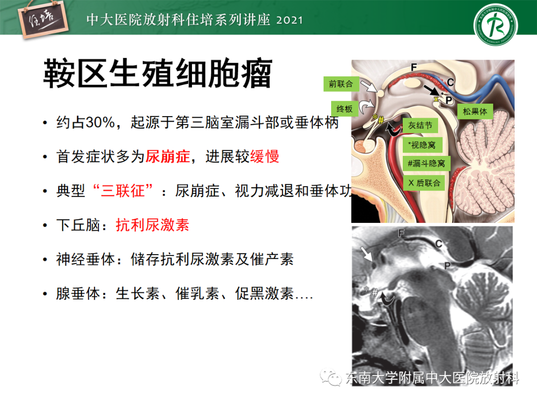影像PPT - 【PPT】颅内生殖细胞瘤影像学表现及鉴别-13