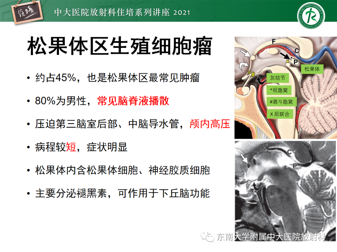 影像PPT - 【PPT】颅内生殖细胞瘤影像学表现及鉴别-15