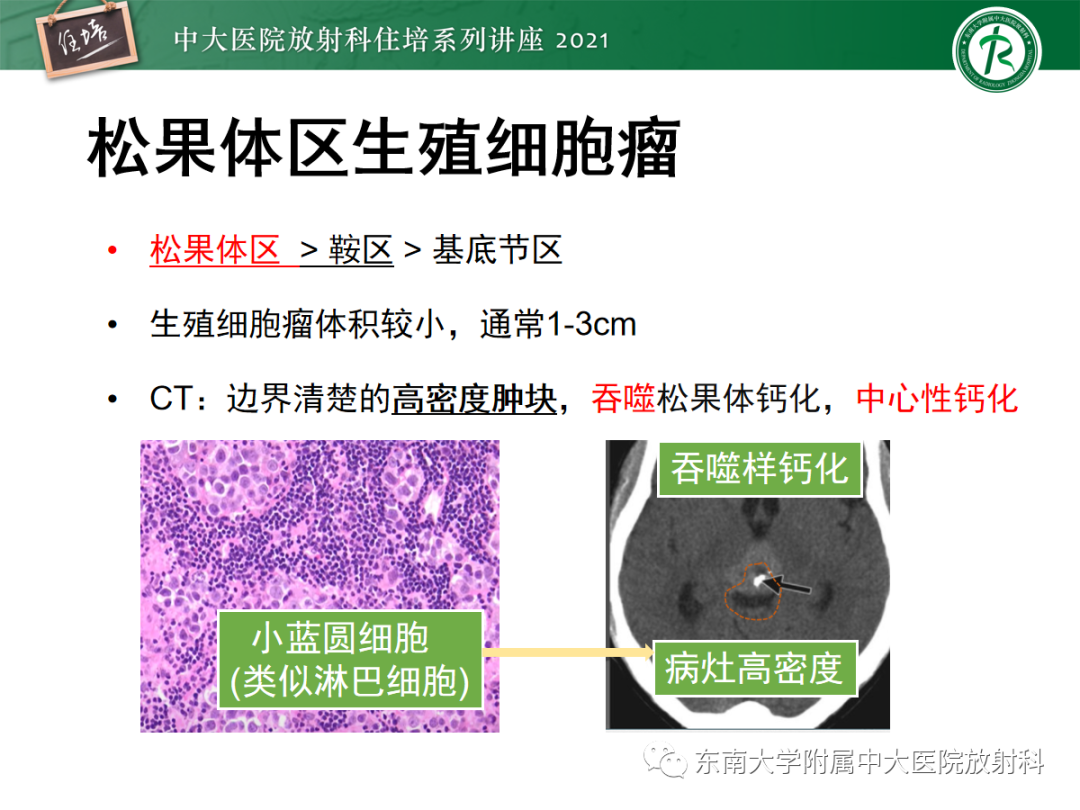影像PPT - 【PPT】颅内生殖细胞瘤影像学表现及鉴别-16