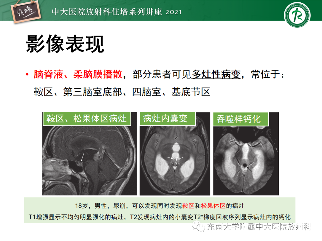 影像PPT - 【PPT】颅内生殖细胞瘤影像学表现及鉴别-17