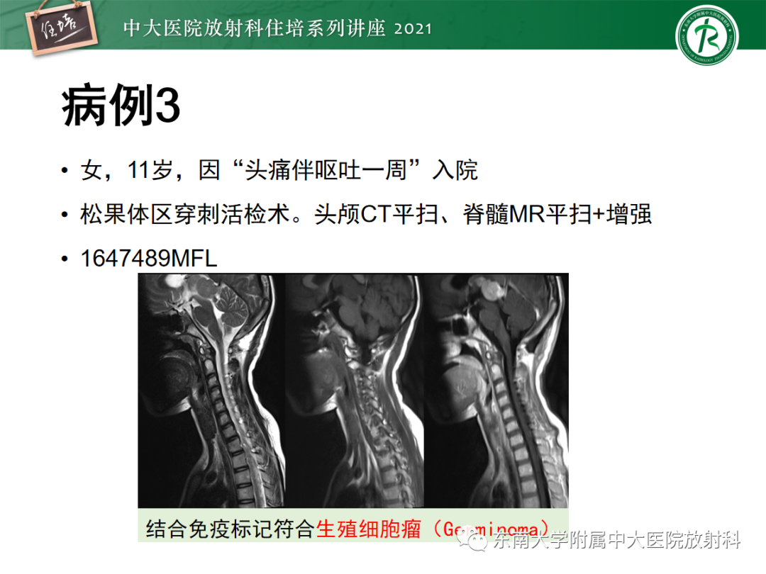 影像PPT - 【PPT】颅内生殖细胞瘤影像学表现及鉴别-18