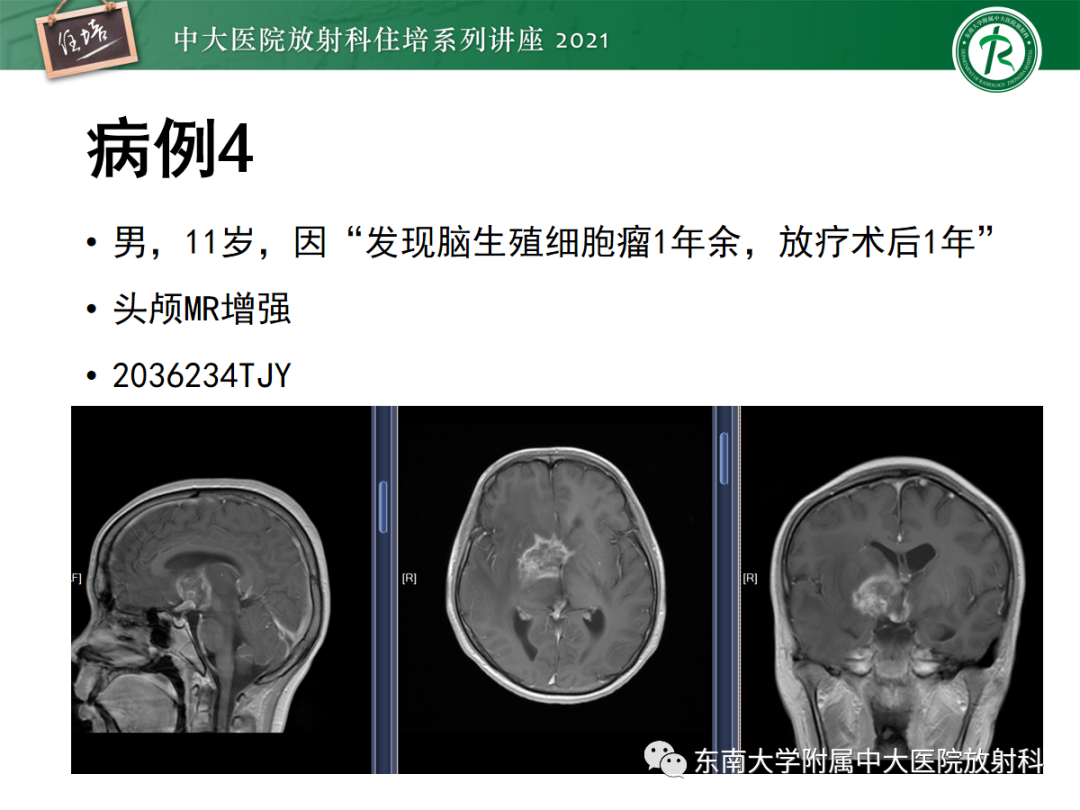 影像PPT - 【PPT】颅内生殖细胞瘤影像学表现及鉴别-20