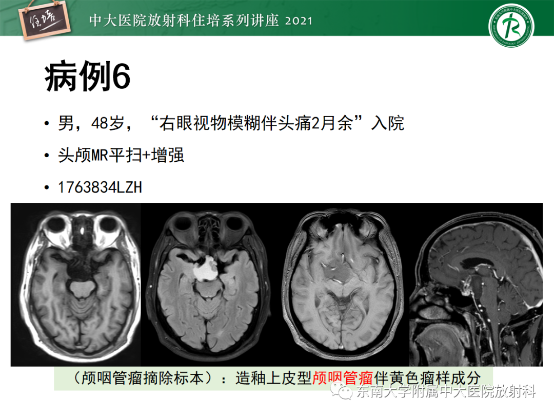 影像PPT - 【PPT】颅内生殖细胞瘤影像学表现及鉴别-25