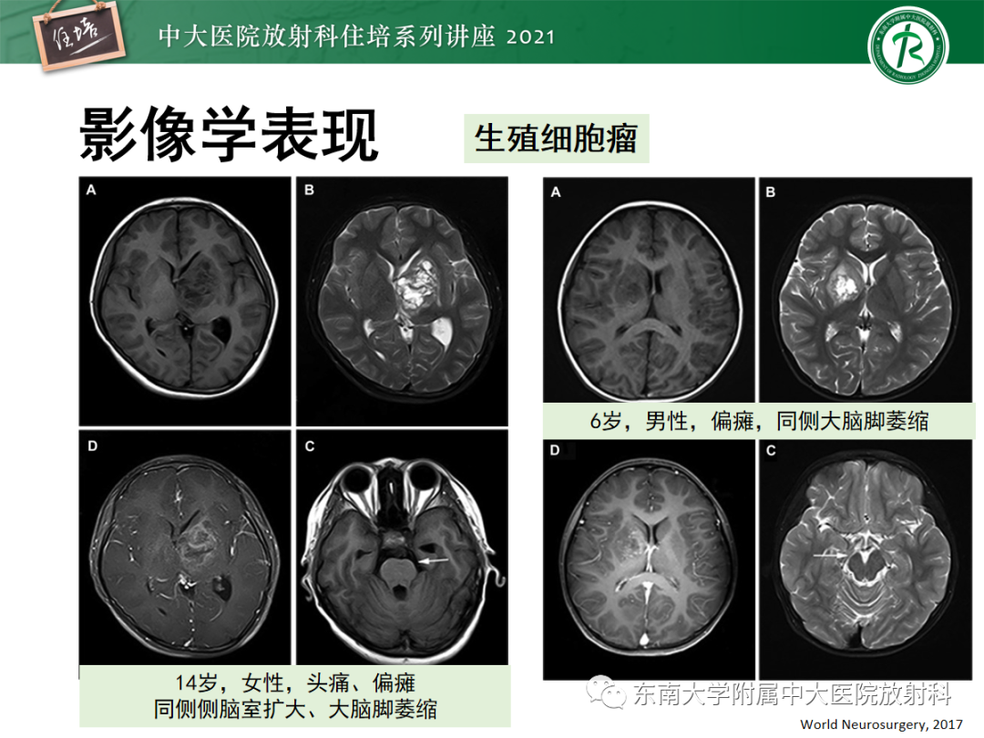 影像PPT - 【PPT】颅内生殖细胞瘤影像学表现及鉴别-21