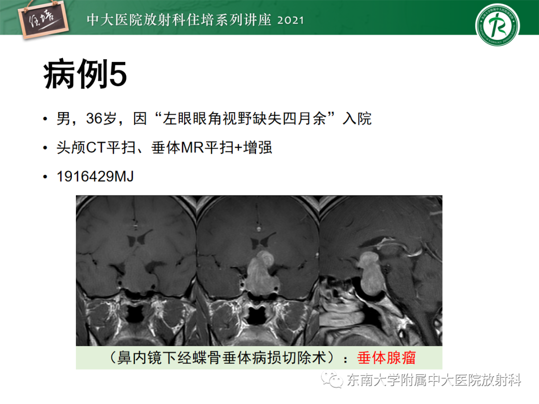影像PPT - 【PPT】颅内生殖细胞瘤影像学表现及鉴别-23