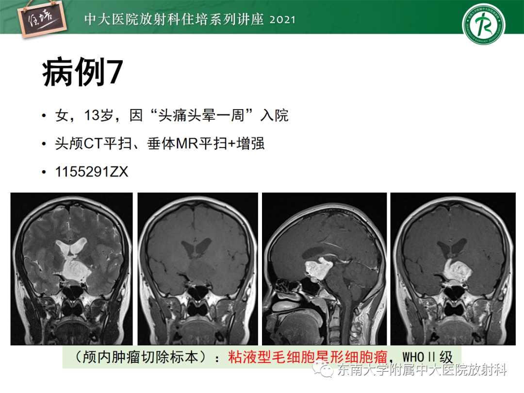 影像PPT - 【PPT】颅内生殖细胞瘤影像学表现及鉴别-27
