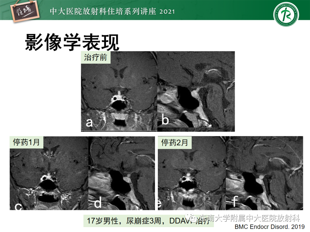 影像PPT - 【PPT】颅内生殖细胞瘤影像学表现及鉴别-30