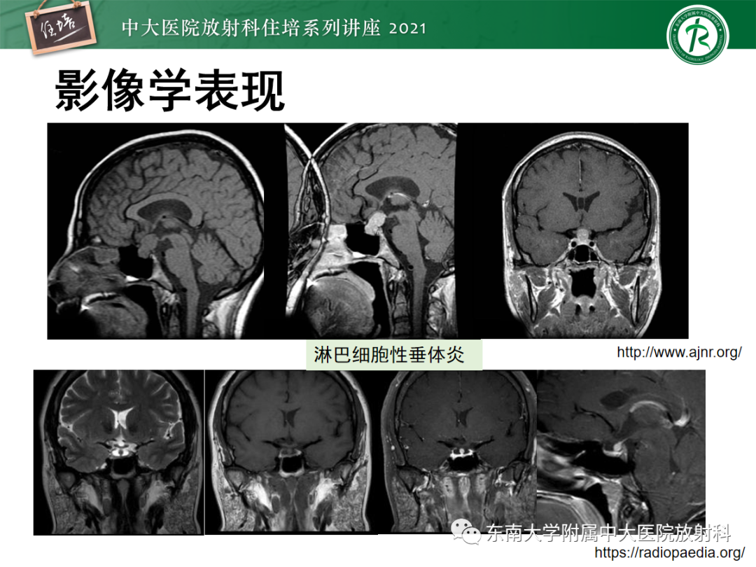 影像PPT - 【PPT】颅内生殖细胞瘤影像学表现及鉴别-32