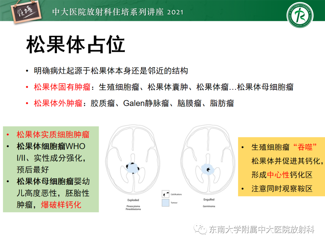 影像PPT - 【PPT】颅内生殖细胞瘤影像学表现及鉴别-33
