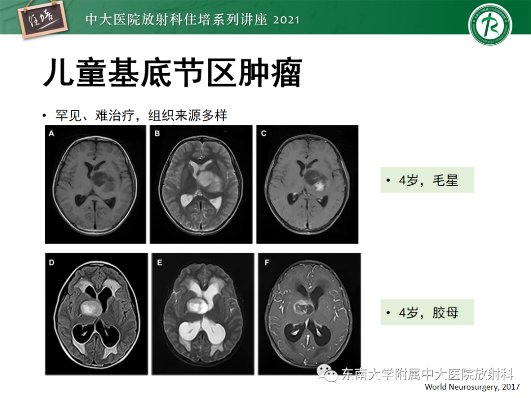 影像PPT - 【PPT】颅内生殖细胞瘤影像学表现及鉴别-35