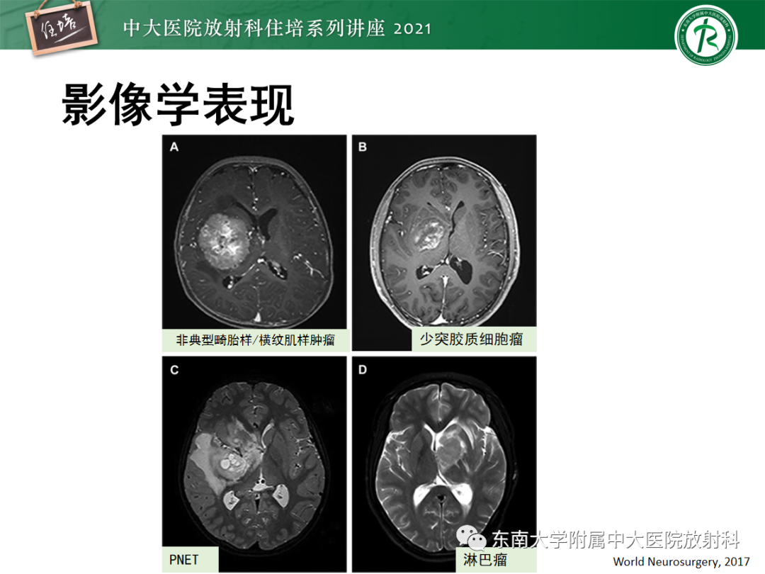 影像PPT - 【PPT】颅内生殖细胞瘤影像学表现及鉴别-36