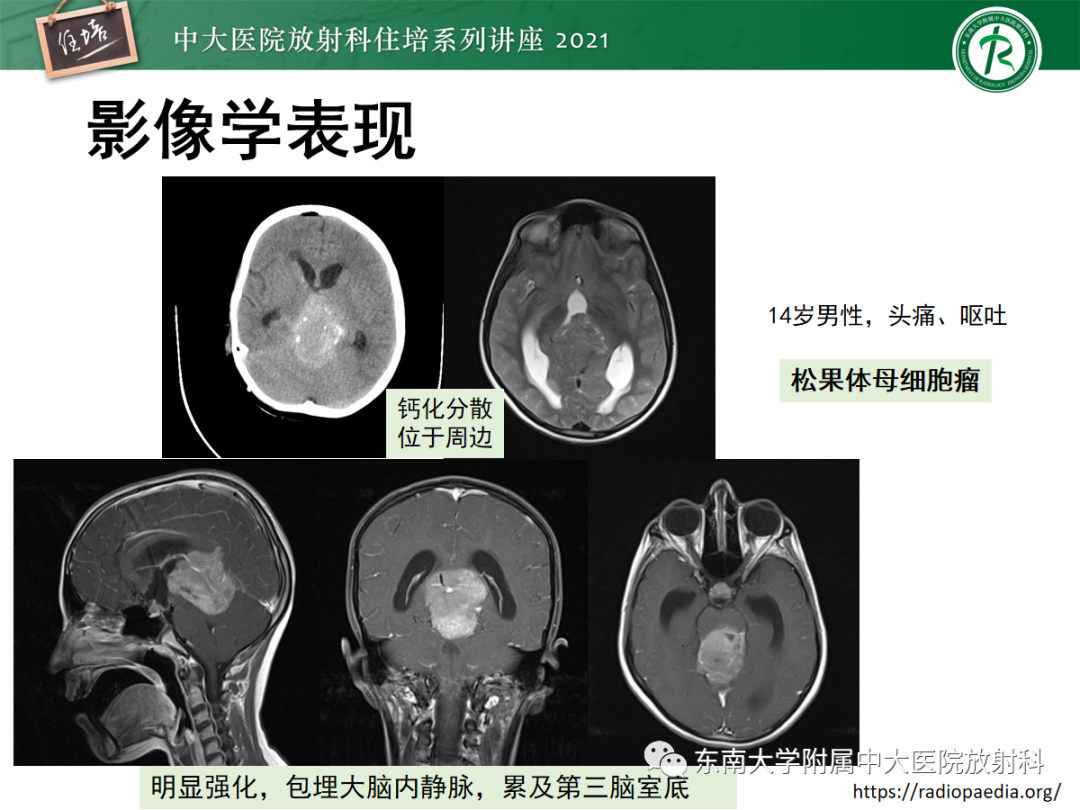 影像PPT - 【PPT】颅内生殖细胞瘤影像学表现及鉴别-34