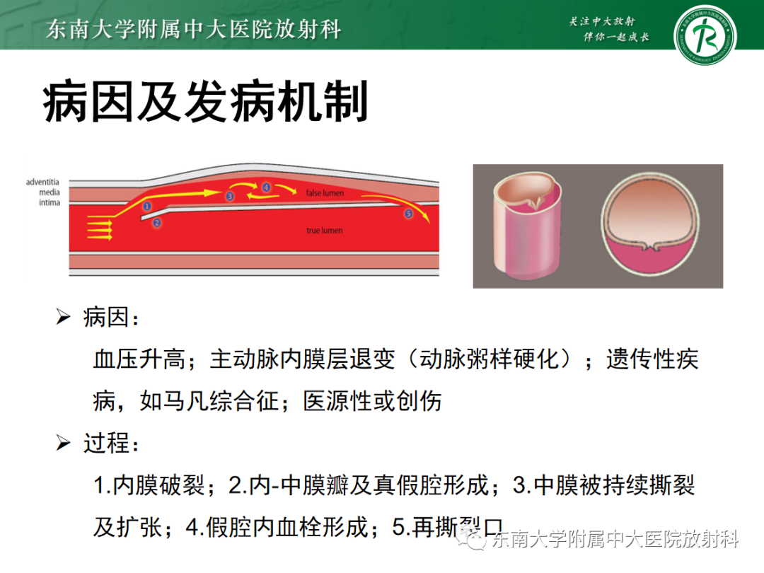 影像PPT - 【PPT】胸痛三联征-9 影像PPT - 【PPT】胸痛三联征-9