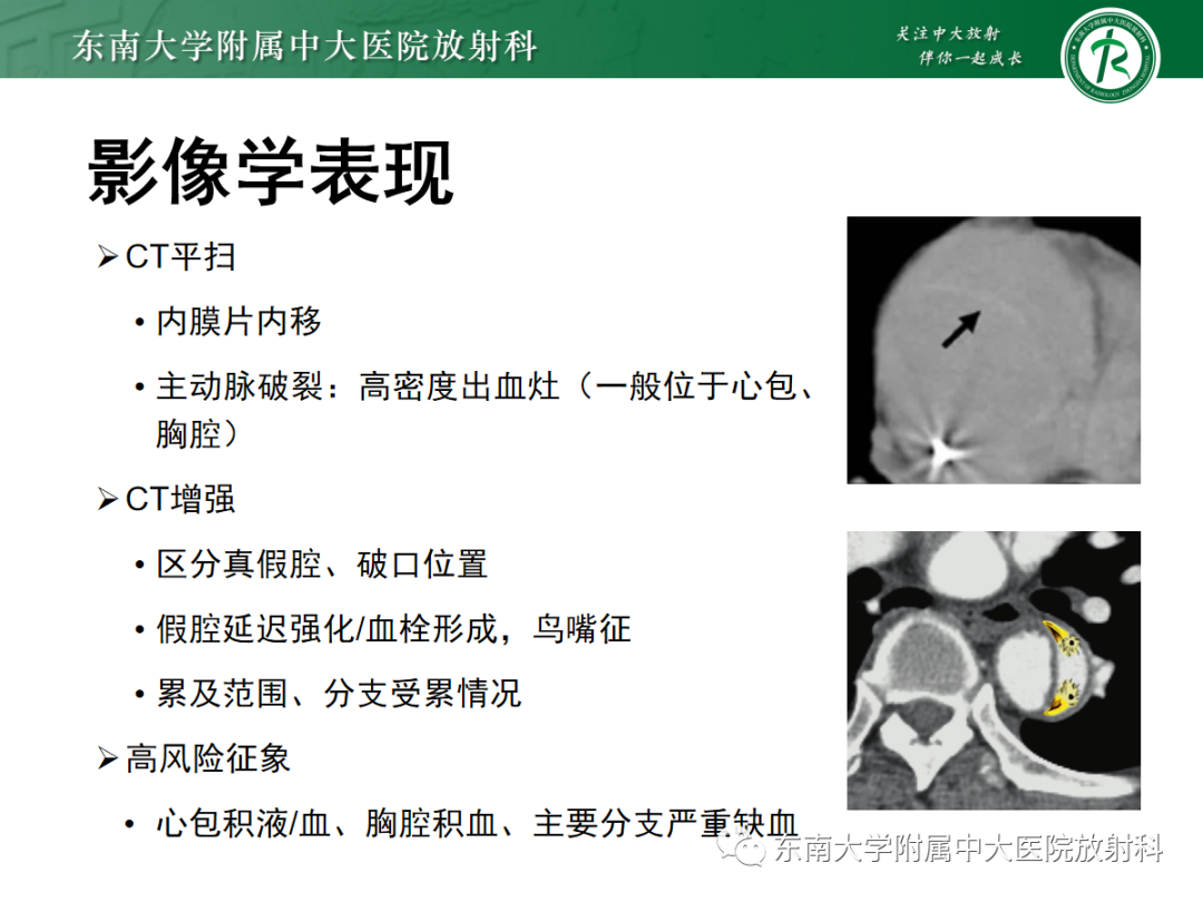 影像PPT - 【PPT】胸痛三联征-12 影像PPT - 【PPT】胸痛三联征-12