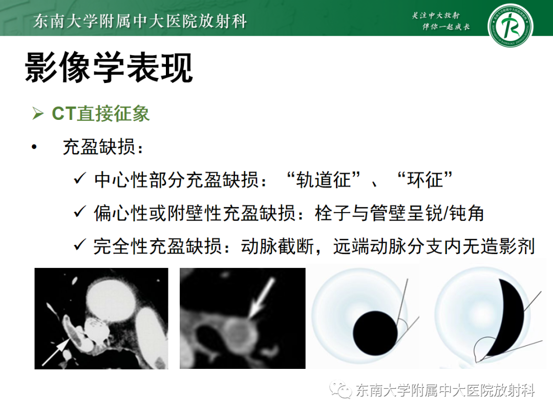 影像PPT - 【PPT】胸痛三联征-19 影像PPT - 【PPT】胸痛三联征-19