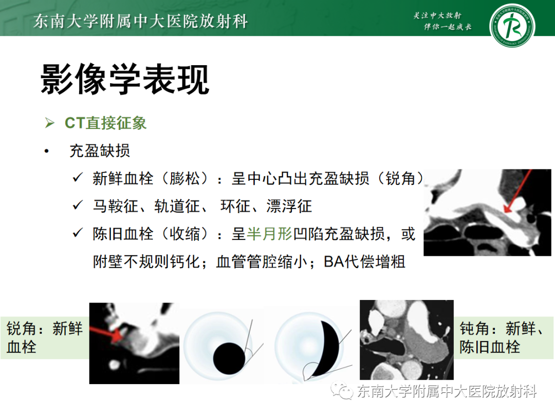 影像PPT - 【PPT】胸痛三联征-20 影像PPT - 【PPT】胸痛三联征-20