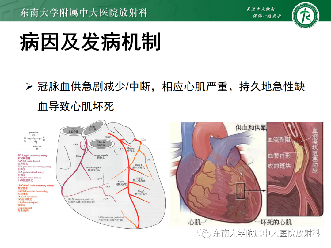 影像PPT - 【PPT】胸痛三联征-24 影像PPT - 【PPT】胸痛三联征-24