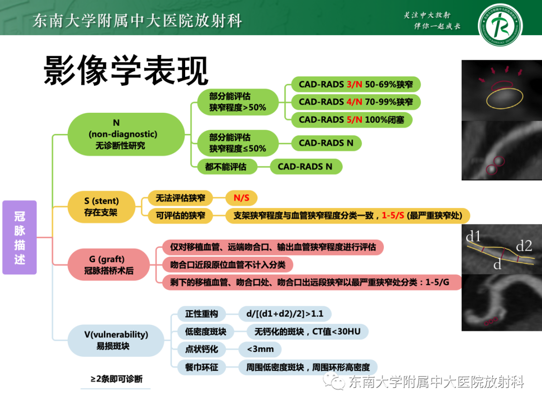 影像PPT - 【PPT】胸痛三联征-29 影像PPT - 【PPT】胸痛三联征-29