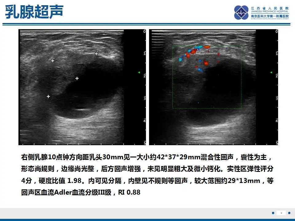 影像PPT - 【PPT】乳腺包裹性乳头状癌-4