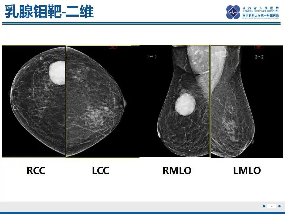 影像PPT - 【PPT】乳腺包裹性乳头状癌-5
