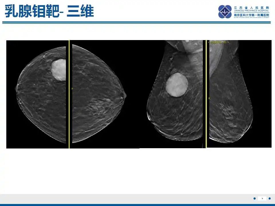 影像PPT - 【PPT】乳腺包裹性乳头状癌-6