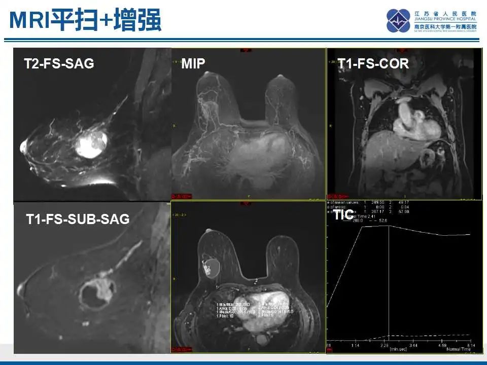 影像PPT - 【PPT】乳腺包裹性乳头状癌-8