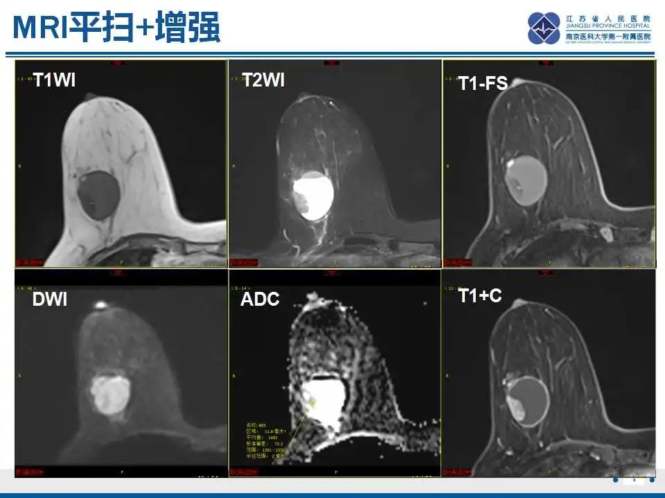 影像PPT - 【PPT】乳腺包裹性乳头状癌-7