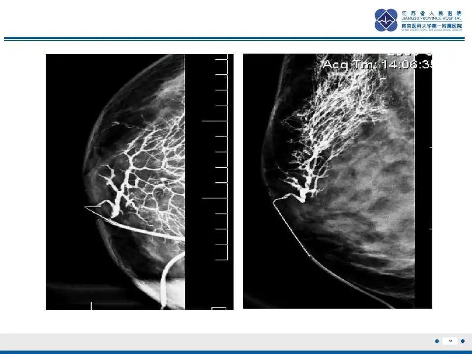影像PPT - 【PPT】乳腺包裹性乳头状癌-11