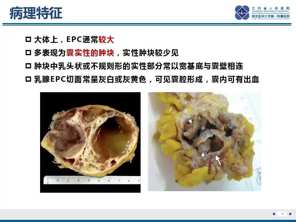 影像PPT - 【PPT】乳腺包裹性乳头状癌-20