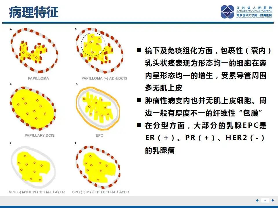 影像PPT - 【PPT】乳腺包裹性乳头状癌-21