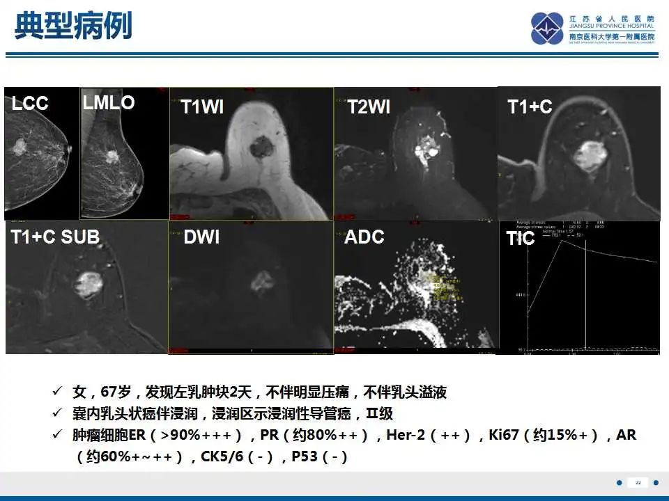 影像PPT - 【PPT】乳腺包裹性乳头状癌-23