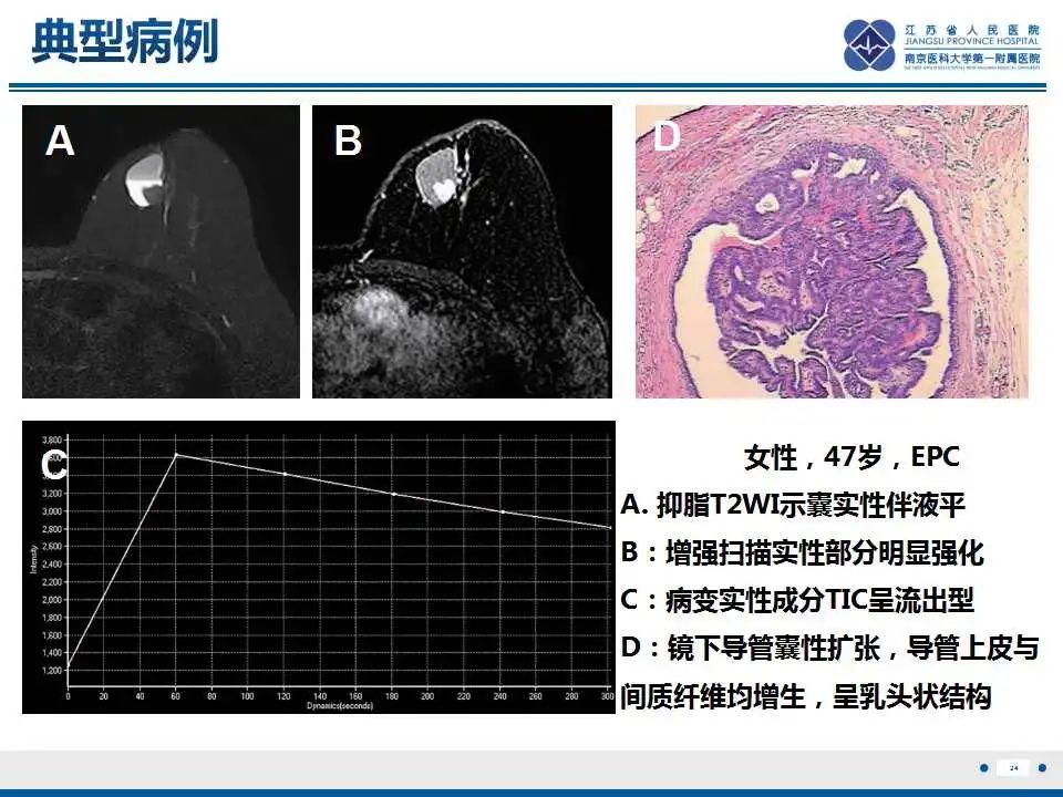 影像PPT - 【PPT】乳腺包裹性乳头状癌-25