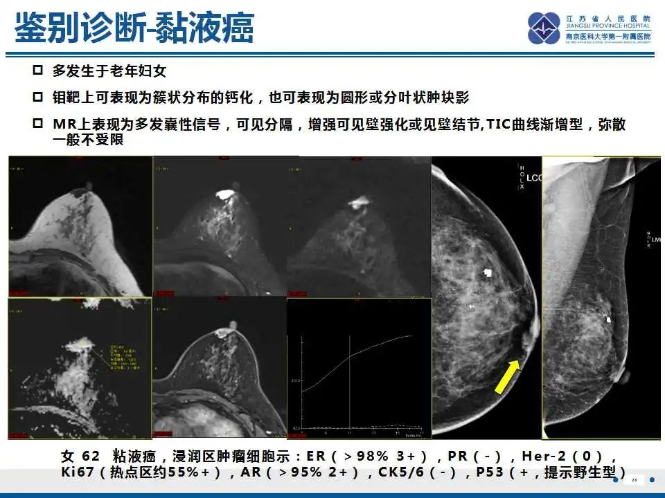 影像PPT - 【PPT】乳腺包裹性乳头状癌-29