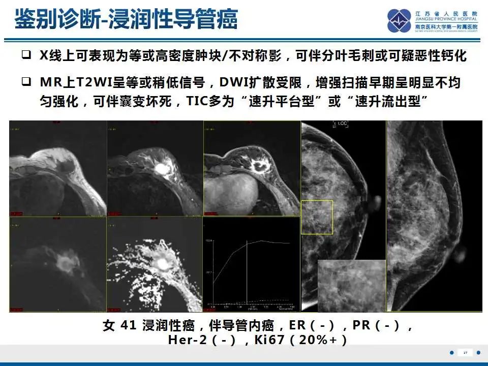 影像PPT - 【PPT】乳腺包裹性乳头状癌-28