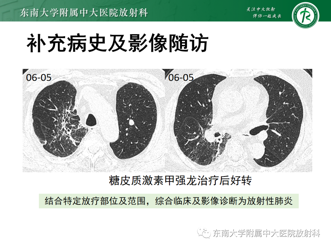 影像PPT - 【PPT】放射性肺损伤-3 影像PPT - 【PPT】放射性肺损伤-3