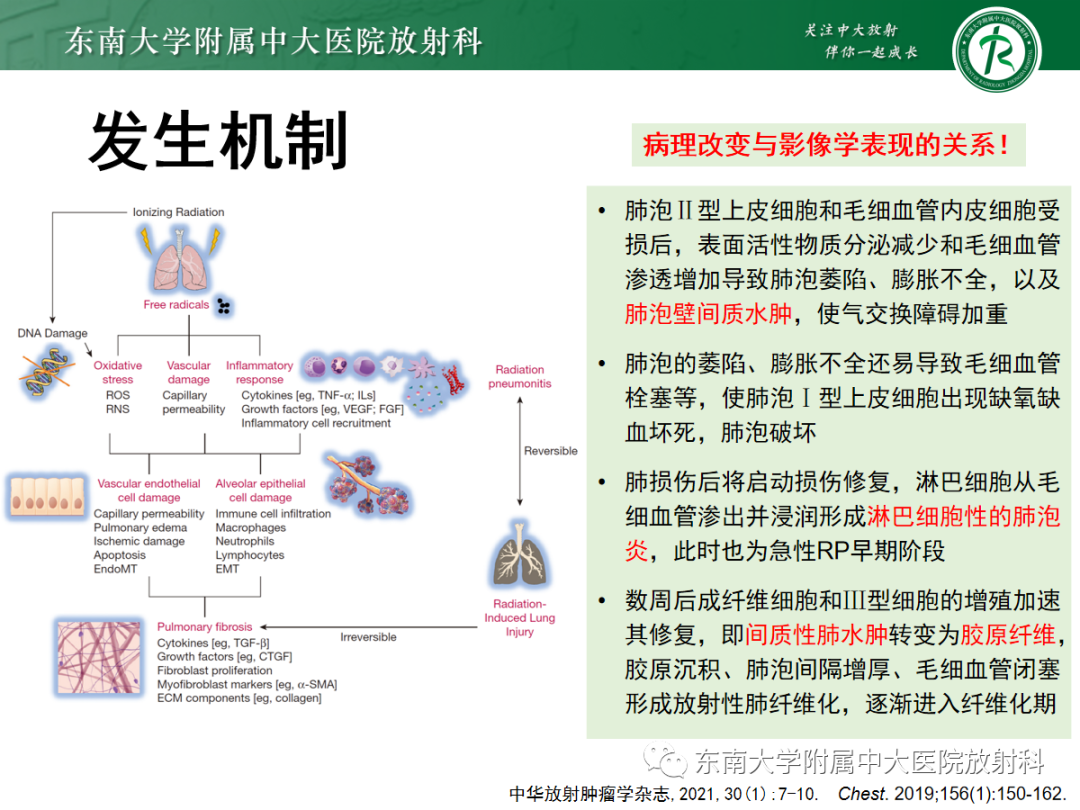 影像PPT - 【PPT】放射性肺损伤-8 影像PPT - 【PPT】放射性肺损伤-8