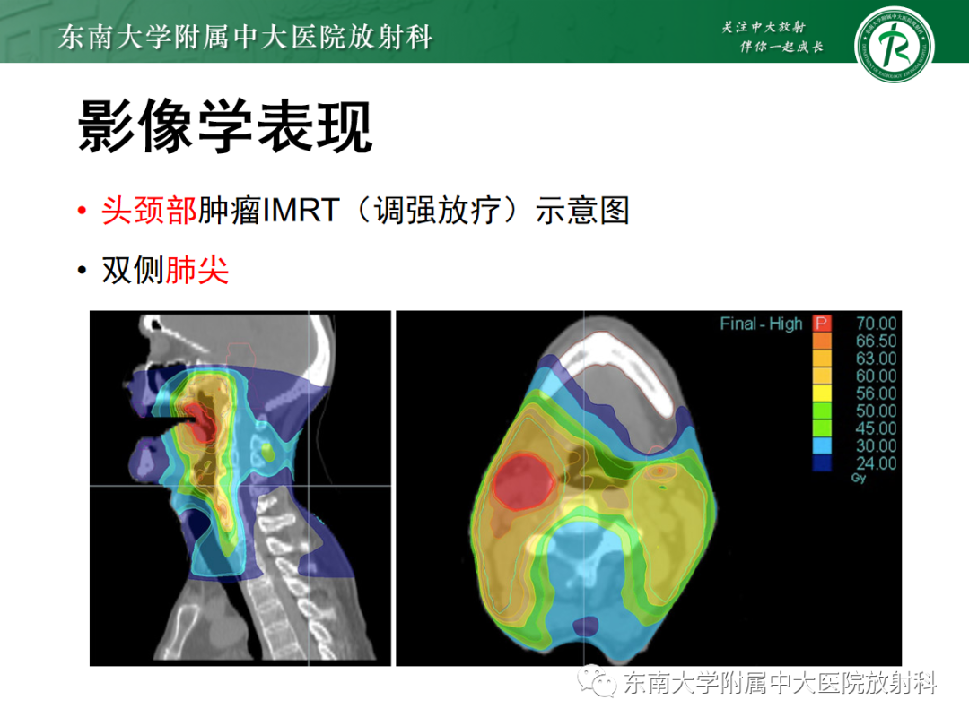 影像PPT - 【PPT】放射性肺损伤-11 影像PPT - 【PPT】放射性肺损伤-11