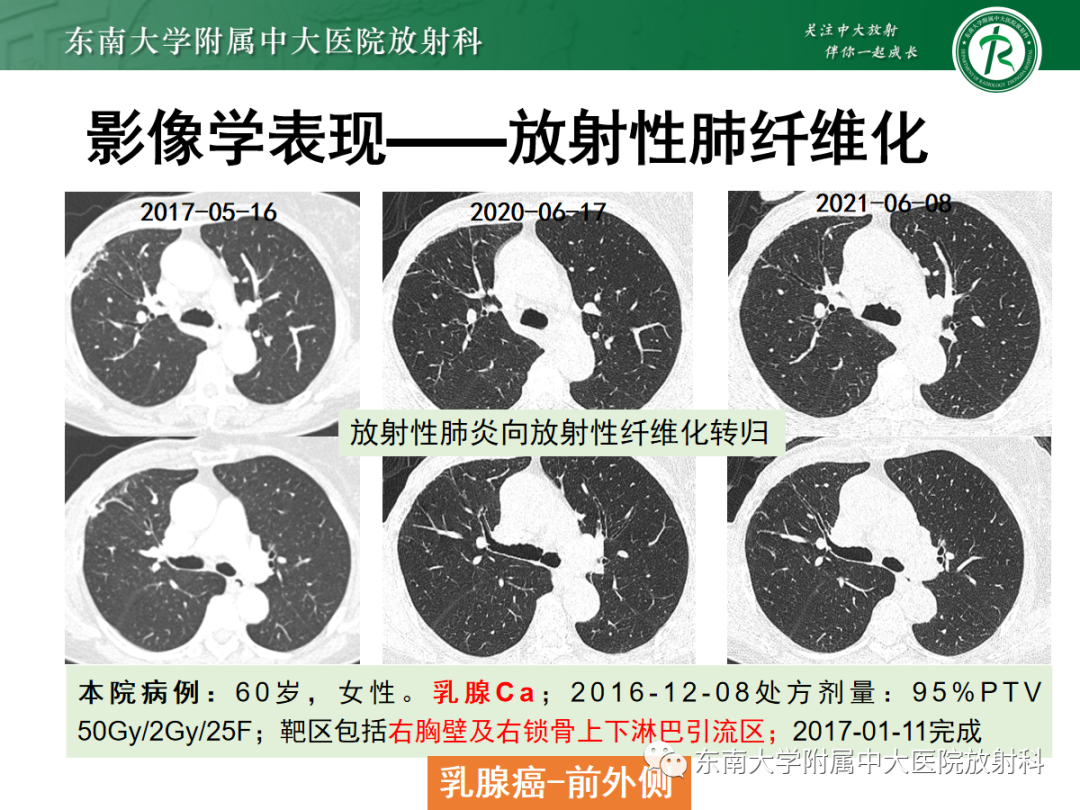 影像PPT - 【PPT】放射性肺损伤-17 影像PPT - 【PPT】放射性肺损伤-17