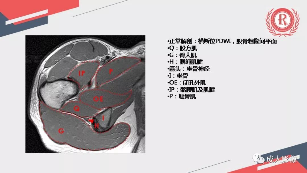 影像PPT - 【PPT】坐骨股骨撞击综合征MR影像诊断-10 影像PPT - 【PPT】坐骨股骨撞击综合征MR影像诊断-10