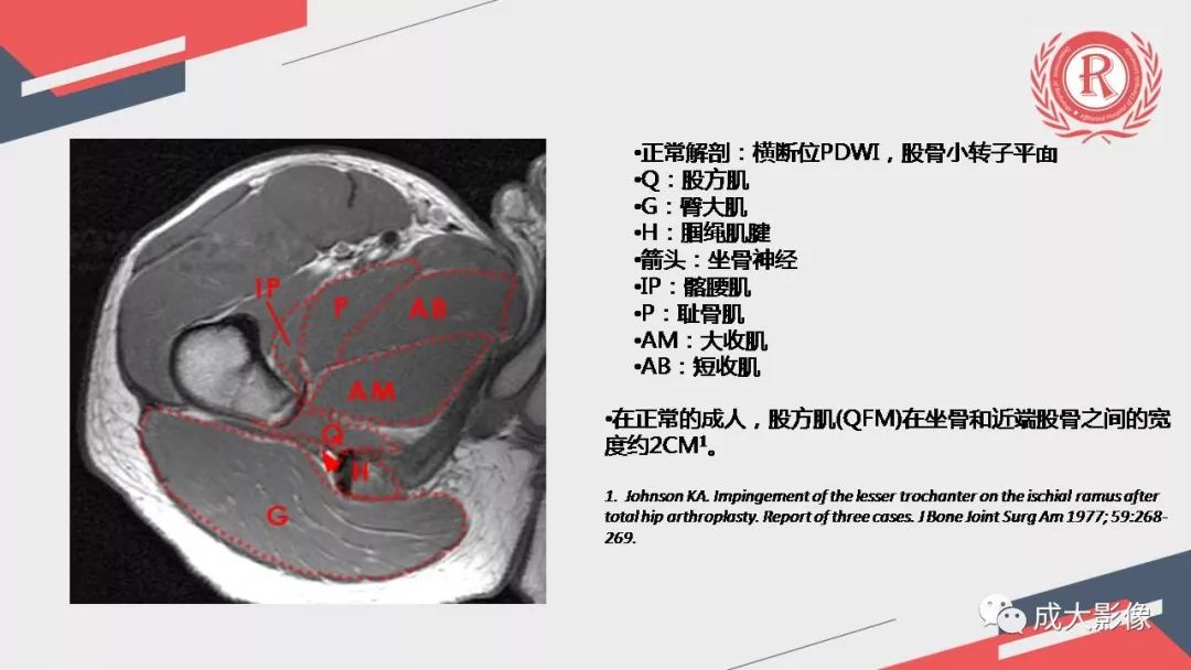 影像PPT - 【PPT】坐骨股骨撞击综合征MR影像诊断-11 影像PPT - 【PPT】坐骨股骨撞击综合征MR影像诊断-11