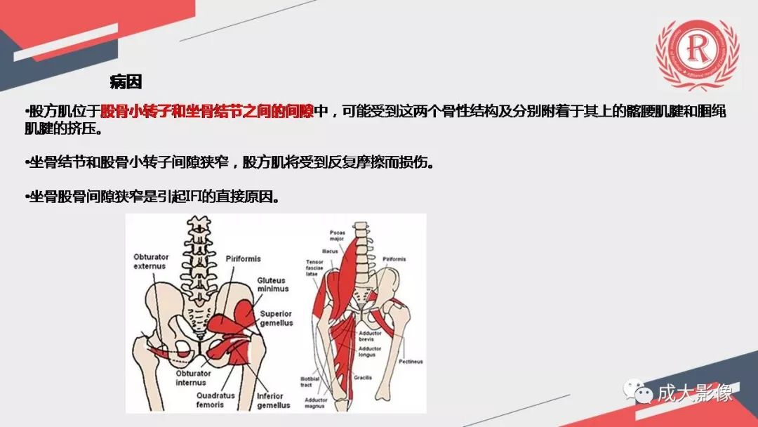 影像PPT - 【PPT】坐骨股骨撞击综合征MR影像诊断-13 影像PPT - 【PPT】坐骨股骨撞击综合征MR影像诊断-13